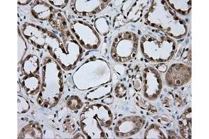 Immunohistochemical staining of paraffin-embedded Carcinoma of liver tissue using anti-NME4 mouse monoclonal antibody. (NME4 抗体)