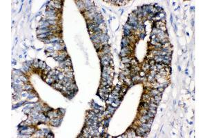 Anti- MAOA Picoband antibody,IHC(P) IHC(P): Human Intestinal Cancer Tissue (Monoamine Oxidase A 抗体  (C-Term))