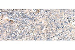 Immunohistochemistry of paraffin-embedded Human cervical cancer tissue using PARS2 Polyclonal Antibody at dilution of 1:30(x200) (PARS2 抗体)