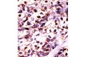 Formalin-fixed and paraffin-embedded human cancer tissue (hepatocarcinoma) reacted with the primary antibody, which was peroxidase-conjugated to the secondary antibody, followed by DAB staining. (UCK2 抗体  (N-Term))