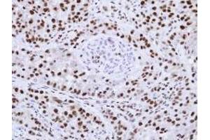 AP19043PU-N hnRNP-F antibody staining of Paraffin-Embedded A549 xenograft at 1/100 dilution. (HNRNPF 抗体  (N-Term))