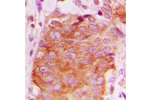 Immunohistochemical analysis of LATH staining in human breast cancer formalin fixed paraffin embedded tissue section.