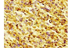 IHC image of ABIN7153749 diluted at 1:300 and staining in paraffin-embedded human glioma performed on a Leica BondTM system. (Gelsolin 抗体  (AA 28-782))