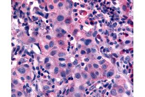 Anti-NANP antibody IHC of human Breast, Carcinoma. (NANP 抗体  (N-Term))