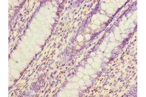 Immunohistochemistry of paraffin-embedded human colon cancer using ABIN7165330 at dilution of 1:100 (EVA1C 抗体  (AA 49-322))