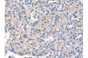 The image on the left is immunohistochemistry of paraffin-embedded Human liver cancer tissue using ABIN7191162(KCNB1 Antibody) at dilution 1/40, on the right is treated with synthetic peptide. (Kv2.1/KCNB1 抗体)