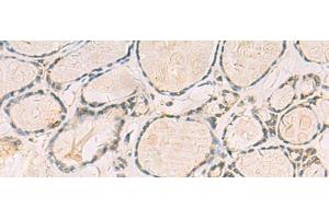 Immunohistochemistry of paraffin-embedded Human thyroid cancer tissue using TCAP Polyclonal Antibody at dilution of 1:55(x200) (TCAP 抗体)