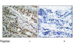 Immunohistochemical analysis of paraffin-embedded human breast carcinoma tissue using FOXO1 polyclonal antibody  . (FOXO1 抗体)