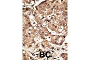 Formalin-fixed and paraffin-embedded human cancer tissue reacted with the primary antibody, which was peroxidase-conjugated to the secondary antibody, followed by AEC staining. (ATG4C 抗体  (C-Term))