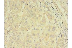 Immunohistochemistry of paraffin-embedded human liver cancer using ABIN7144889 at dilution of 1:100 (ABCB5 抗体  (AA 547-760))
