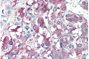 Human Adrenal (formalin-fixed, paraffin-embedded) stained with CARD9 antibody ABIN214431 at 10 ug/ml followed by biotinylated goat anti-rabbit IgG secondary antibody ABIN481713, alkaline phosphatase-streptavidin and chromogen. (CARD9 抗体  (AA 521-536))