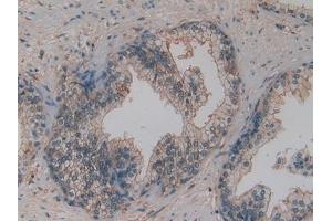 Detection of OPN in Human Prostate cancer Tissue using Polyclonal Antibody to Osteopontin (OPN) (Osteopontin 抗体  (AA 17-287))