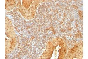 Formalin-fixed, paraffin-embedded human Salivary Tumor stained with Cytochrome C Mouse Monoclonal Antibody (7H8. (Cytochrome C 抗体  (AA 1-80))