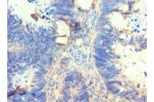 Immunohistochemistry of paraffin-embedded human ovarian cancer using ABIN7162566 at dilution of 1:100 (AMY2A 抗体  (AA 242-511))