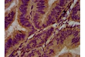 IHC image of ABIN7143399 diluted at 1:400 and staining in paraffin-embedded human endometrial cancer performed on a Leica BondTM system. (Adhesion G Protein-Coupled Receptor G1 (ADGRG1) (AA 26-216) 抗体)