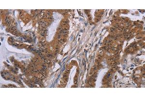 Immunohistochemistry of paraffin-embedded Human esophagus cancer tissue using GRK1 Polyclonal Antibody at dilution 1:40 (GRK1 抗体)