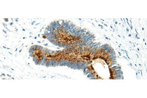 Immunohistochemistry of paraffin-embedded Human colorectal cancer using WWOX Polyclonal Antibody at dilution of 1/20 (WWOX 抗体)