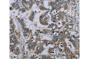 Immunohistochemistry of Human liver cancer using PCK2 Polyclonal Antibody at dilution of 1:60 (PEPCK 抗体)
