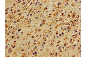 IHC image of ABIN7160401 diluted at 1:400 and staining in paraffin-embedded human glioma performed on a Leica BondTM system. (MBP 抗体  (AA 1-197))