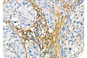 ABIN6265941 and ABIN6272458 at 1/100 staining Human pancreatic cancer by IHC-P.