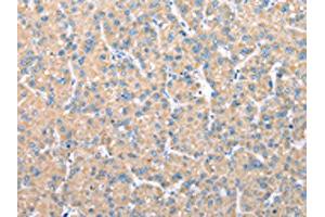 The image on the left is immunohistochemistry of paraffin-embedded Human liver cancer tissue using ABIN7128073(VAPA Antibody) at dilution 1/30, on the right is treated with fusion protein. (VAPA 抗体)