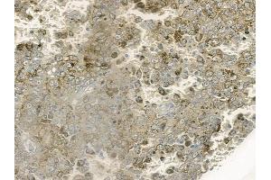 ABIN6264671 and ABIN6273069 at 1/100 staining human melanoma by IHC-P. (RBM4 抗体  (Internal Region))