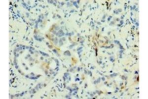 Immunohistochemistry of paraffin-embedded human lung cancer using ABIN7159272 at dilution of 1:100 (MAGEA6 抗体  (AA 75-314))