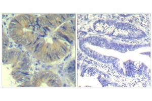 Immunohistochemical analysis of paraffin-embedded human colon carcinoma tissue using chk2 (phospho-Ser33) Antibody (E011527). (CHEK2 抗体  (pSer33))