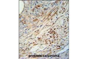 KIF9 antibody immunohistochemistry analysis in formalin fixed and paraffin embedded human prostate carcinoma followed by peroxidase conjugation of the secondary antibody and DAB staining. (KIF9 抗体  (C-Term))