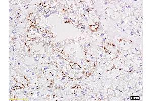 Formalin-fixed and paraffin embedded human colon carcinoma tissue labeled with Anti VEGF Polyclonal Antibody, unconjugated (ABIN674829) at 1:200 followed by incubation with conjugated secondary antibody and DAB staining.