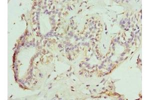 Immunohistochemistry of paraffin-embedded human breast cancer using ABIN7161014 at dilution of 1:100 (NOX5 抗体  (AA 661-765))