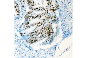 Immunohistochemical analysis of HCFC1 staining in human colon cancer formalin fixed paraffin embedded tissue section. (HCFC1 抗体  (N-Term))