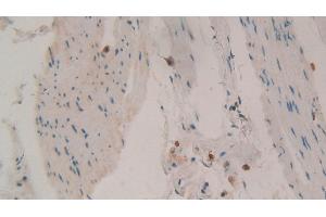 Detection of TIMP1 in Human Stomach cancer Tissue using Polyclonal Antibody to Tissue Inhibitors Of Metalloproteinase 1 (TIMP1) (TIMP1 抗体  (AA 25-207))