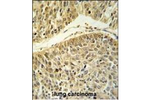 RERE Antibody (N-term) (ABIN653912 and ABIN2843149) IHC analysis in formalin fixed and paraffin embedded lung carcinoma followed by peroxidase conjugation of the secondary antibody and DAB staining. (RERE 抗体  (N-Term))