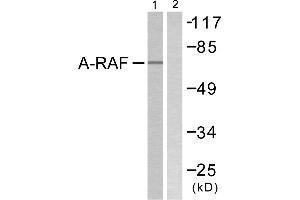 Immunohistochemistry analysis of paraffin-embedded human breast carcinoma tissue using A-RAF (Ab-301/302) antibody. (ARAF 抗体  (Tyr301, Tyr302))