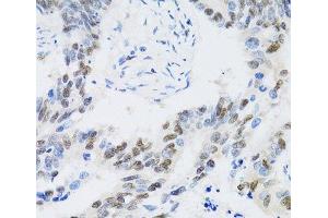 Immunohistochemistry of paraffin-embedded Human colon carcinoma using CDK6 Polyclonal Antibody at dilution of 1:100 (40x lens). (CDK6 抗体)