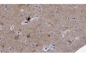ABIN6278497 at 1/100 staining Human brain cancer tissue by IHC-P. (Reticulon 4 抗体  (Internal Region))