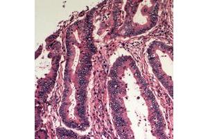 Immunohistochemical analysis of Apolipoprotein L3 staining in human colon cancer formalin fixed paraffin embedded tissue section. (APOL3 抗体  (Center))