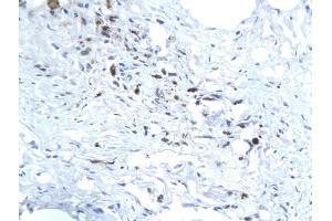 Formalin-fixed and paraffin embedded human liver labeled with Anti-Hepatitis E Virus ORF3 Polyclonal Antibody, Unconjugated (ABIN726350) followed by conjugation to the secondary antibody and DAB staining (HEV ORF3 抗体  (AA 22-103))