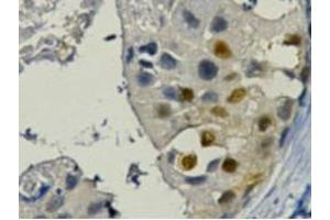 Immunohistochemistry (IHC) staining of Human Breast cancer tissue paraffin-embedded, diluted at 1:200. (PCNA 抗体)