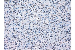 Immunohistochemical staining of paraffin-embedded liver tissue using anti-CHEK2mouse monoclonal antibody. (CHEK2 抗体)