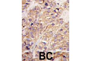 Formalin-fixed and paraffin-embedded human breast carcinoma tissue reacted with SMURF1 polyclonal antibody  , which was peroxidase-conjugated to the secondary antibody, followed by DAB staining. (SMURF1 抗体  (N-Term))