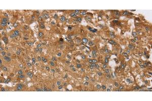 Immunohistochemistry of paraffin-embedded Human liver cancer tissue using RPS6KA2 Polyclonal Antibody at dilution 1:40 (RPS6KA2 抗体)