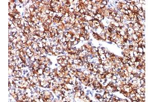 Formalin-fixed, paraffin-embedded human Renal Cell Carcinoma stained with CAIX Mouse Monoclonal Antibody (CA9/781). (CA9 抗体)