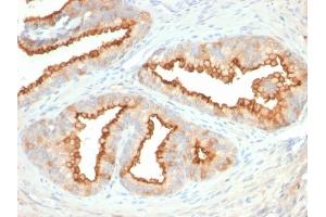 Formalin-fixed, paraffin-embedded human Prostate Carcinoma stained with CD10 Mouse Monoclonal Antibody (MME/2579). (MME 抗体  (AA 583-740))