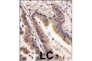 Formalin-fixed and paraffin-embedded human lung carcinoma tissue reacted with ERK4 antibody (C-term), which was peroxidase-conjugated to the secondary antibody, followed by DAB staining. (MAPK7 抗体  (C-Term))