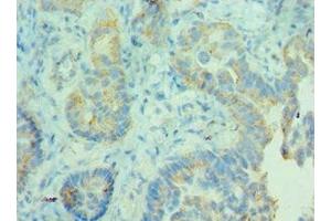 Immunohistochemistry of paraffin-embedded human lung cancer using ABIN7158946 at dilution of 1:100 (MDH2 抗体  (AA 59-338))