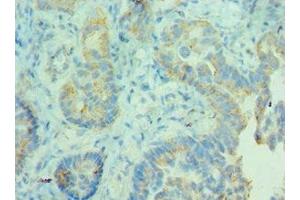 Immunohistochemistry of paraffin-embedded human lung cancer using ABIN7158946 at dilution of 1:100 (MDH2 抗体  (AA 59-338))
