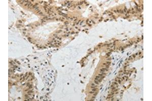 The image on the left is immunohistochemistry of paraffin-embedded Human colon cancer tissue using ABIN7130225(MGEA5 Antibody) at dilution 1/20, on the right is treated with fusion protein. (MGEA5 抗体)