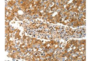 The image on the left is immunohistochemistry of paraffin-embedded Human breast cancer tissue using (TEP1 Antibody) at dilution 1/40, on the right is treated with synthetic peptide. (TEP1 抗体)